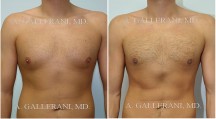 Gynecomastia (Male Breast Reduction) - Patient A