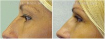 Blepharoplasty - Patient A