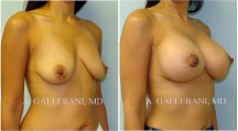 Breast Lift - Patient A