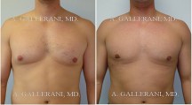 Gynecomastia (Male Breast Reduction) - Patient B