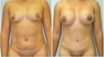 Abdominoplasty - Patient B
