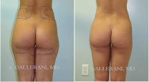 Liposuction - Patient B