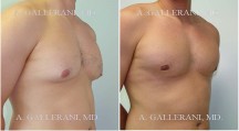 Gynecomastia (Male Breast Reduction) - Patient B