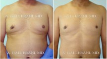 Gynecomastia (Male Breast Reduction) - Patient C