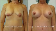 Breast Lift - Patient C