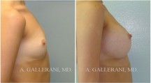 Breast Augmentation - Patient B