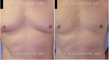 Gynecomastia (Male Breast Reduction) - Patient D
