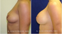 Breast Augmentation - Patient C