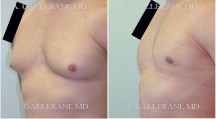 Gynecomastia (Male Breast Reduction) - Patient D