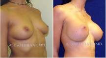 Breast Augmentation - Patient C