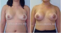 Breast Augmentation - Patient D