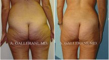Liposuction - Patient E