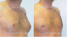 Gynecomastia (Male Breast Reduction) - Patient E