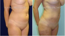 Liposuction - Patient F