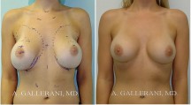 Breast Reconstruction - Patient F