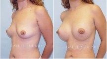 Breast Augmentation - Patient G