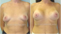 Breast Augmentation - Patient H