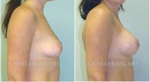 Breast Augmentation - Patient H