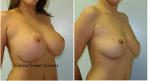 Breast Reconstruction - Patient J