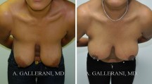 Breast Lift - Patient F