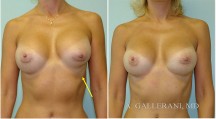 Breast Reconstruction - Patient H