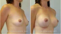Breast Augmentation - Patient E