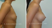 Breast Augmentation - Patient K