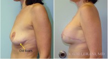 Breast Reconstruction - Patient L
