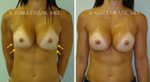 Breast Reconstruction - Patient A