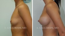 Breast Augmentation - Patient K
