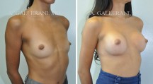 Breast Augmentation - Patient L