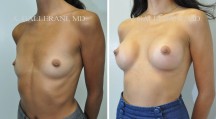 Breast Augmentation - Patient L