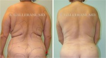 Liposuction - Patient K