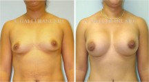 Breast Augmentation - Patient F