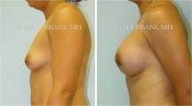 Breast Augmentation - Patient F