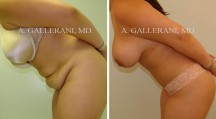 Abdominoplasty - Patient D