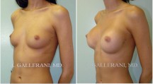 Breast Augmentation - Patient J