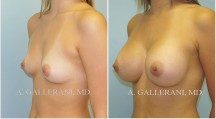 Breast Augmentation - Patient A