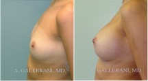 Breast Augmentation - Patient B