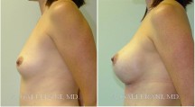 Breast Augmentation - Patient E