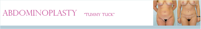 Abdominoplasty (Tummy Tuck) Gallery